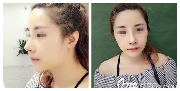 做完假体隆鼻术后五天鼻子恢复情况 做完假体隆鼻术后五天鼻子恢复情况