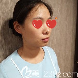 到武汉美基元做玻尿酸垫下巴术前的短下颏 到武汉美基元做玻尿酸垫下巴术前的短下颏