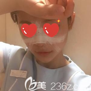 胡煜医生帮我做玻尿酸垫下巴+鼻综合术后即刻 胡煜医生帮我做玻尿酸垫下巴+鼻综合术后即刻