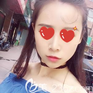 胡医生做玻尿酸垫下巴术后65天下巴轮廓自然 胡医生做玻尿酸垫下巴术后65天下巴轮廓自然