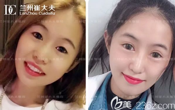 兰州崔大夫割双眼皮技术怎么样 全切双眼皮和鼻综合隆鼻第10天效果值得一看