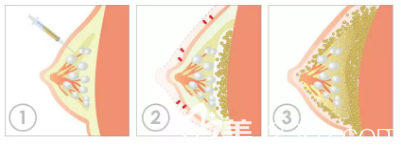 自体脂肪丰胸的流程图