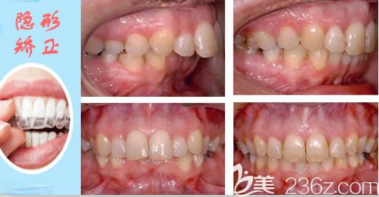 上海美维口腔成人龅牙矫正案例图
