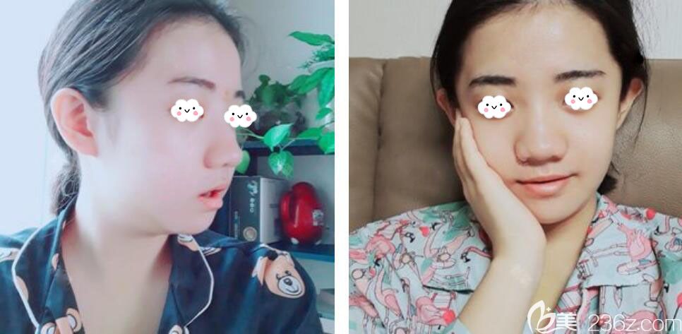 韩国EU颌面轮廓整形双鄂手术术后7天恢复效果图