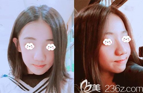 韩国EU金钟润院长突嘴矫正真人案例