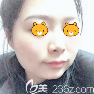 盛医生帮我做激光祛斑术后7天斑点消失