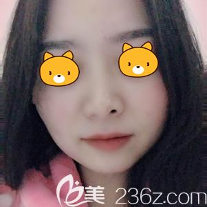 做激光祛斑术后25天浅层班脸部消失