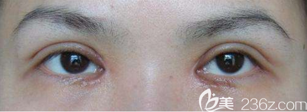 双眼皮手术失败图片