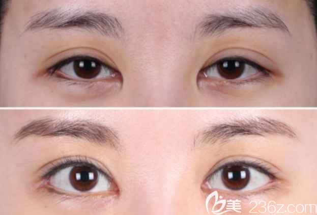 双眼皮矫正手术前后对比照片