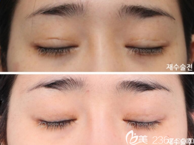 双眼皮疤痕增生图片与修复效果