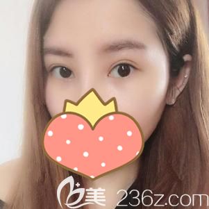 做自体脂肪丰额头术后28天淤青消失抽脂部位恢复 做自体脂肪丰额头术后28天淤青消失抽脂部位恢复