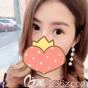 做自体脂肪填充太阳穴术后饱满自然 做自体脂肪填充太阳穴术后饱满自然