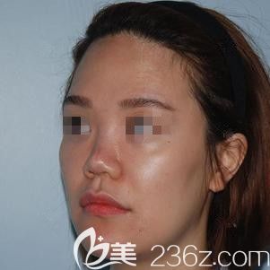 在张家口天宏做脂肪填充+鼻综合术前是凹陷脸和塌鼻子 在张家口天宏做脂肪填充+鼻综合术前是凹陷脸和塌鼻子