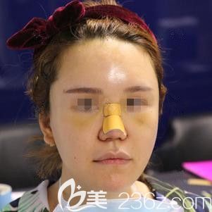 <!--<i data=20240703-sp></i>-->东医生为我做脂肪填充和鼻综合术后面部肿胀 <!--<i data=20240703-sp></i>-->东医生为我做脂肪填充和鼻综合术后面部肿胀