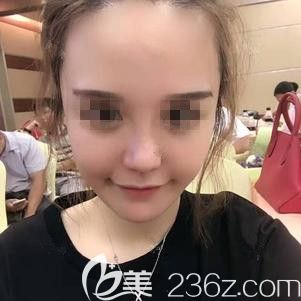 在张家口天宏做脂肪填充+鼻综合术后10天慢慢恢复中 在张家口天宏做脂肪填充+鼻综合术后10天慢慢恢复中