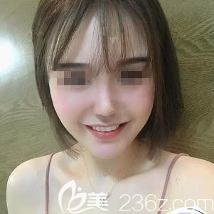 <!--<i data=20240703-sp></i>-->东医生为我做脂肪填充和鼻综合术后28天慢慢消肿 <!--<i data=20240703-sp></i>-->东医生为我做脂肪填充和鼻综合术后28天慢慢消肿