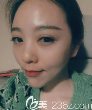 重庆好美整形自体脂肪全脸填充术后半个月