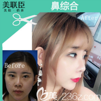 杨辉医生隆鼻案例