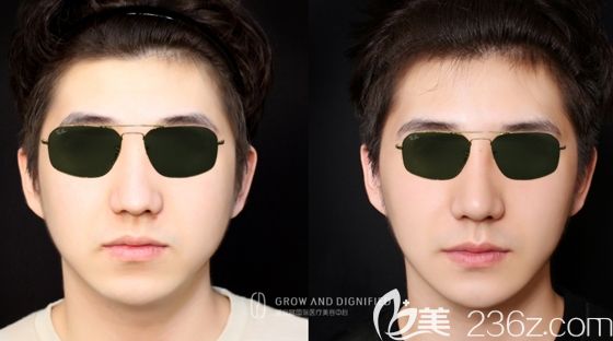 长春姬安娣整形面部轮廓整形前后对比图 长春姬安娣整形面部轮廓整形前后对比图