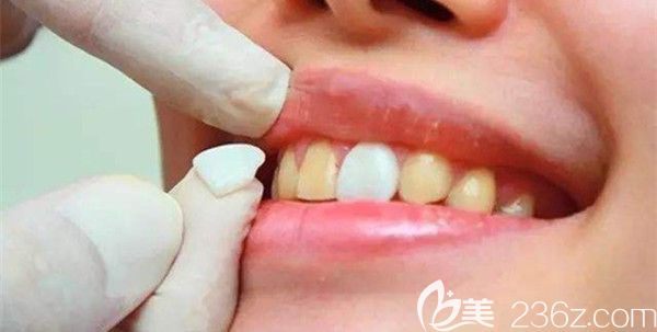 做完牙齿贴面后不会掉色