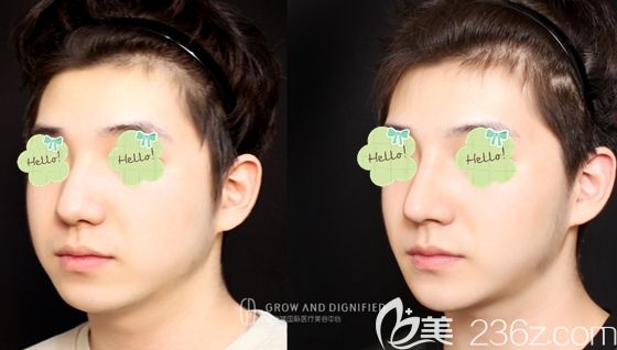 长春姬安娣整形驼峰鼻矫正和下巴整形前后对比效果 长春姬安娣整形驼峰鼻矫正和下巴整形前后对比效果