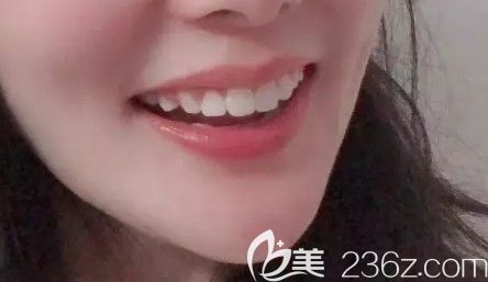 我去上海美维口腔花6万多元做了牙性+骨性龅牙矫正,今天来点评下隐适美矫正的效果怎么样吧！