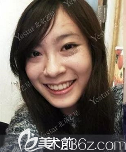 我在北京艺星祛眼袋前样子 我在北京艺星祛眼袋前样子