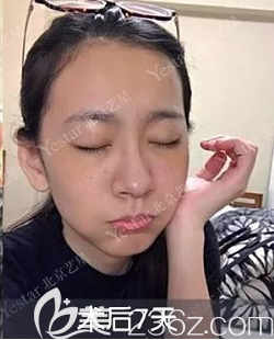 选择北京祛眼袋好的医院北京艺星做了无痕内切祛眼袋第7天样子 选择北京祛眼袋好的医院北京艺星做了无痕内切祛眼袋第7天样子