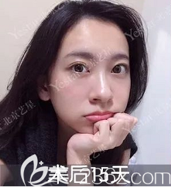 我在北京艺星医院做无痕内切祛眼袋半个月效果 我在北京艺星医院做无痕内切祛眼袋半个月效果