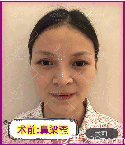 我在北京美莱做歪鼻矫正前样子 我在北京美莱做歪鼻矫正前样子