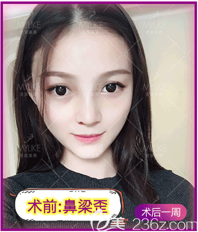 <!--<i data=20240703-sp></i>-->医生给我做鼻梁歪矫正手术第7天效果 <!--<i data=20240703-sp></i>-->医生给我做鼻梁歪矫正手术第7天效果