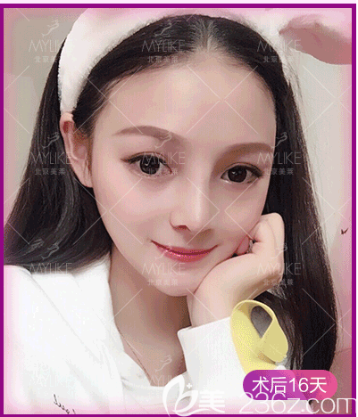 我找北京做歪鼻矫正还好的<!--<i data=20240703-sp></i>-->医生做歪鼻矫正第16天效果 我找北京做歪鼻矫正还好的<!--<i data=20240703-sp></i>-->医生做歪鼻矫正第16天效果