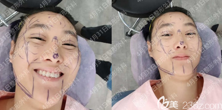 韩国金载勋鼻综合隆鼻+自体脂肪面部填充手术过程