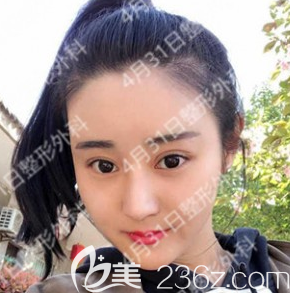 韩国4月31日整形金载勋双眼皮+鼻综合隆鼻+自体脂肪填充全脸案例术后半年恢复图