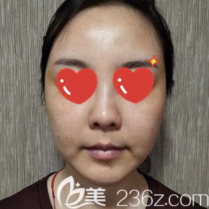 到武汉美基元面诊前法令纹木偶纹明显的自己 到武汉美基元面诊前法令纹木偶纹明显的自己