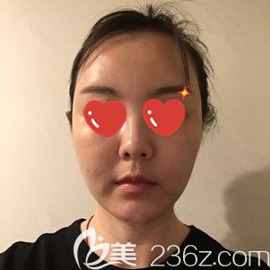 李莎主任帮我做射频紧肤术后1天脸部肿胀 李莎主任帮我做射频紧肤术后1天脸部肿胀
