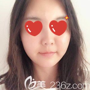 做射频紧肤+热玛吉术后15天皱纹变淡 做射频紧肤+热玛吉术后15天皱纹变淡
