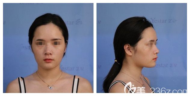 注射过几次玻尿酸隆鼻山根变宽 注射过几次玻尿酸隆鼻山根变宽