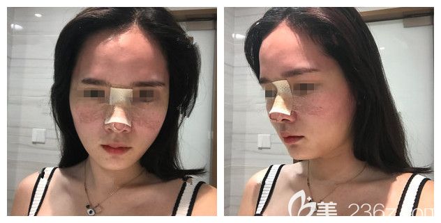 耳软骨垫鼻尖+艳冠假体鼻修复术后三天恢复情况 耳软骨垫鼻尖+艳冠假体鼻修复术后三天恢复情况