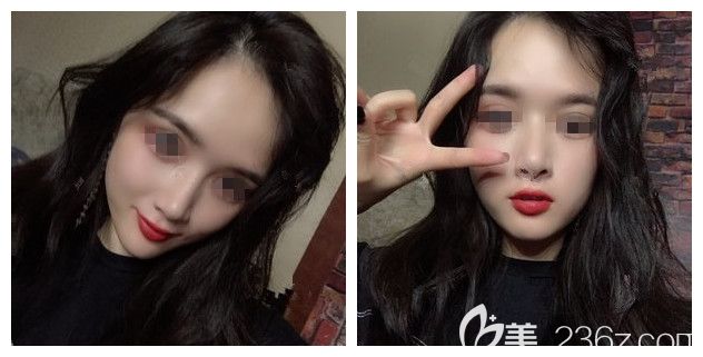 拆线后耳软骨垫鼻尖+艳冠假体鼻修复恢复 拆线后耳软骨垫鼻尖+艳冠假体鼻修复恢复