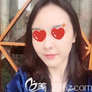 李主任做射频紧肤术后36天肿胀消除 李主任做射频紧肤术后36天肿胀消除