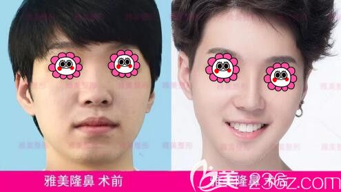 雅美膨体假体隆鼻真人前后对比效果
