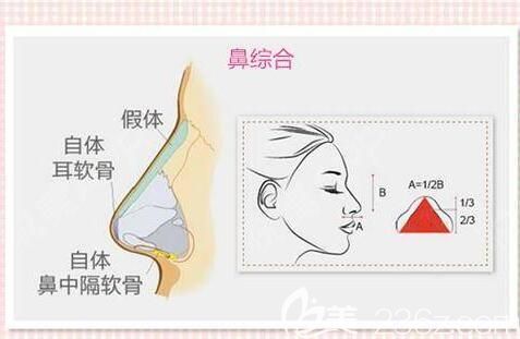 哪种隆鼻效果自然挺立