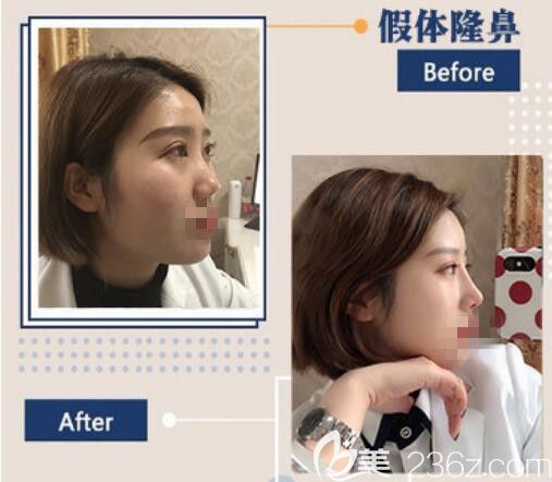 洛阳华美假体鼻综合前后对比照片