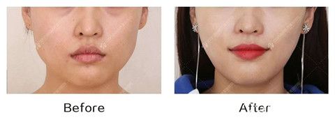 沈阳百嘉丽注射瘦脸瘦脸真人前后效果对比照