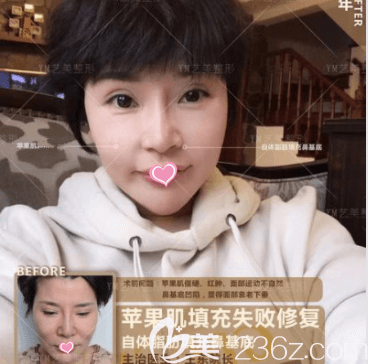 北京艺美王东医生面部脂肪填充失败修复