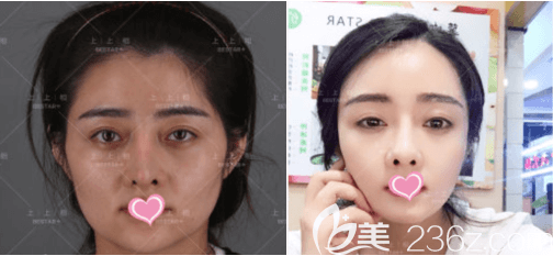 北京上上相郑楚蓉面部脂肪填充失败修复