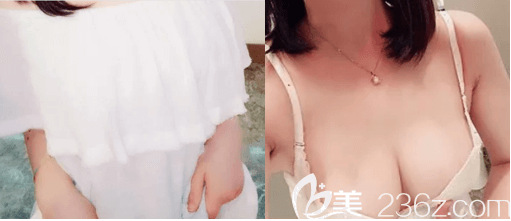 冯斌医生胸部脂肪填充失败修复