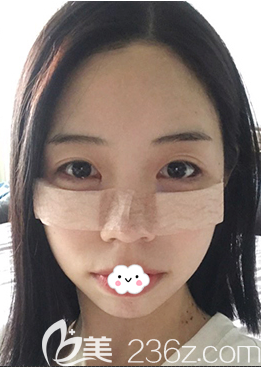 韩国K-angle整形外科眼底脂肪重置术后第1天恢复效果图