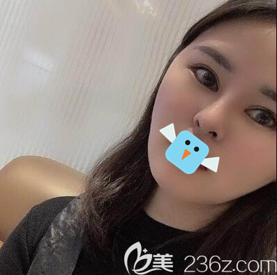 成都艾米丽程红涛给我做了面部吸脂和眼综合，我还是不满足又做了假体鼻综合，现在的我才是我想要的